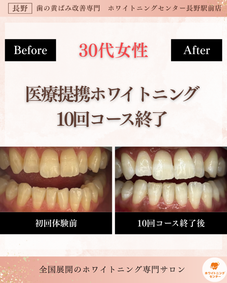 長野市_ホワイトニング_ホワイトニングセンター長野駅前の医療提携ホワイトニング10回コース終了後のビフォーアフター