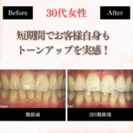 長野市_ホワイトニング_ホワイトニングセンター長野駅前店で短期間でトーンアップを実感