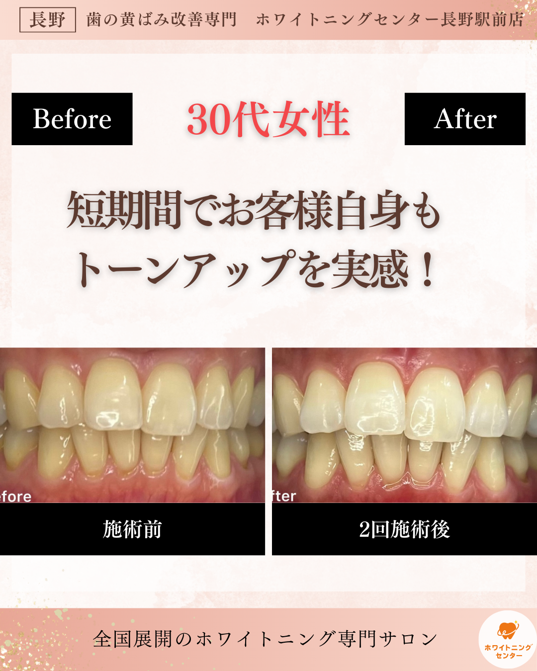 長野市_ホワイトニング_ホワイトニングセンター長野駅前店で短期間でトーンアップを実感