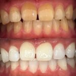 ホワイトニングセンター長野駅前店の医療提携ホワイトニングで黄ばみを劇的改善した30代男性のビフォーアフター写真