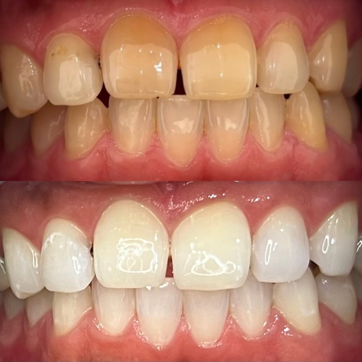 ホワイトニングセンター長野駅前店の医療提携ホワイトニングで黄ばみを劇的改善した30代男性のビフォーアフター写真