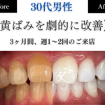 ホワイトニングセンター長野駅前店の医療提携ホワイトニングで黄ばみを劇的に改善したビフォーアフター写真