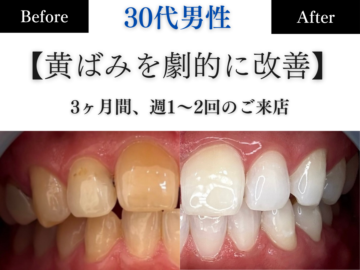 ホワイトニングセンター長野駅前店の医療提携ホワイトニングで黄ばみを劇的に改善したビフォーアフター写真