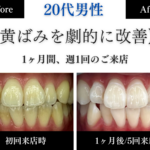 ホワイトニングセンター長野駅前店の医療提携ホワイトニングで1ヶ月で黄ばみが劇的に改善した20代男性のビフォーアフター写真
