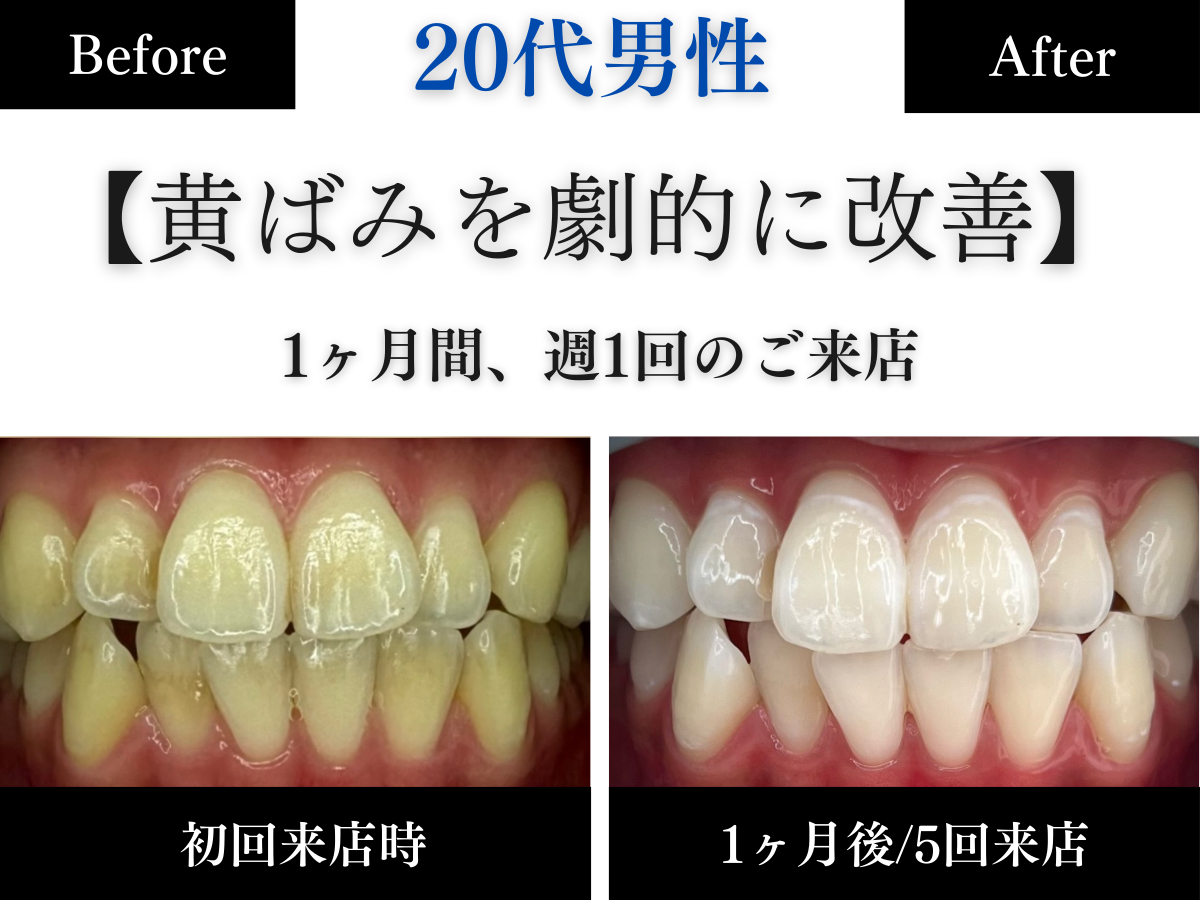 ホワイトニングセンター長野駅前店の医療提携ホワイトニングで1ヶ月で黄ばみが劇的に改善した20代男性のビフォーアフター写真