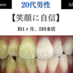 ホワイトニングセンター長野駅前店の医療提携ホワイトニングで黄ばみを劇的に改善し笑顔に自信を持った男性のビフォーアフター写真