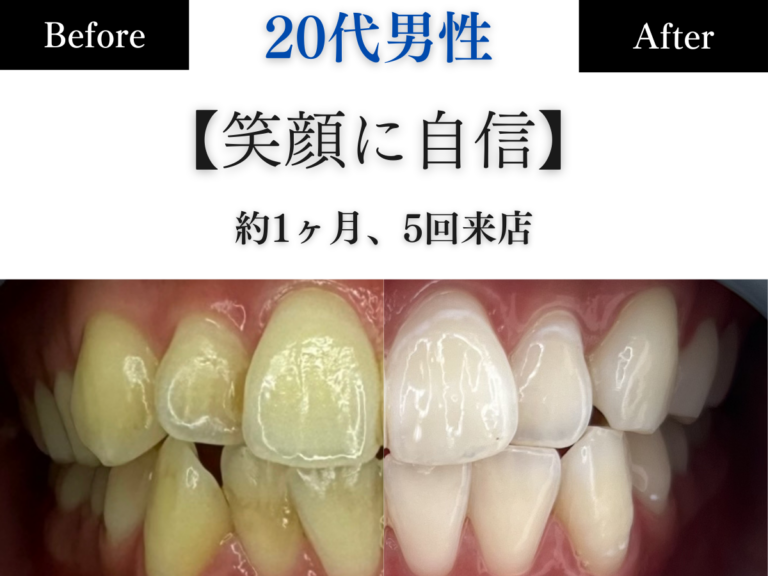 ホワイトニングセンター長野駅前店の医療提携ホワイトニングで黄ばみを劇的に改善し笑顔に自信を持った男性のビフォーアフター写真