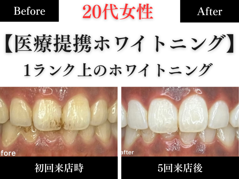 長野市のホワイトニングセンター長野駅前店でワンランク上のホワイトニングをして黄ばみが改善した20代女性のビフォーアフター写真