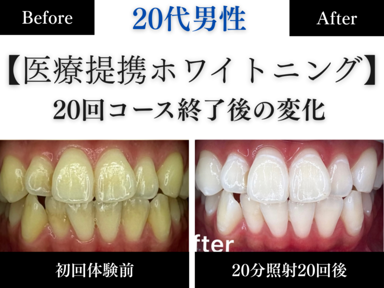 ホワイトニングセンター長野駅前店の医療提携ホワイトニングで歯の黄ばみを改善し白くなった20代男性のビフォーアフター写真