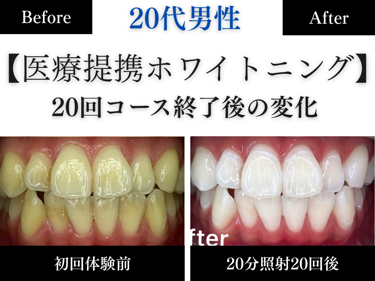 ホワイトニングセンター長野駅前店の医療提携ホワイトニングで歯の黄ばみを改善し白くなった20代男性のビフォーアフター写真