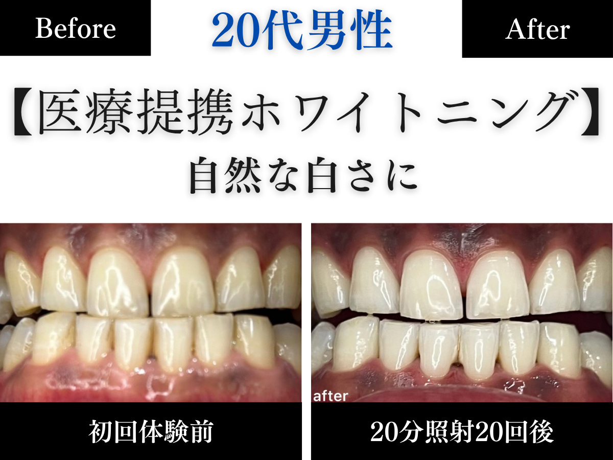 ホワイトニングセンター長野駅前店の医療提携ホワイトニングで自然な歯の白さになった20代男性のビフォーアフター写真