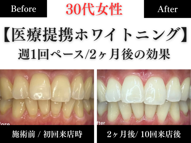 長野市のホワイトニングセンター長野駅前店で医療提携ホワイトニングをした30代女性の2ヶ月後の効果の写真