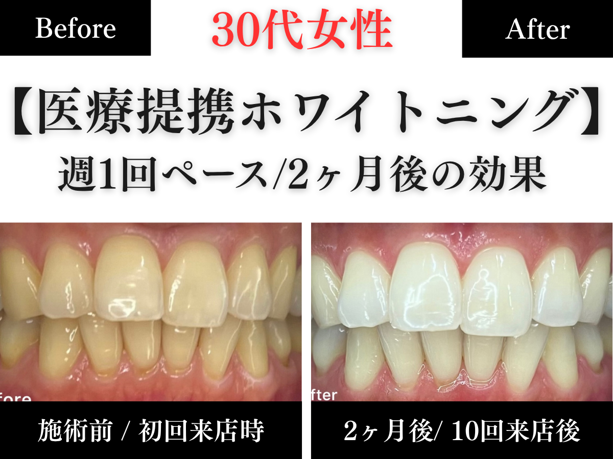 長野市のホワイトニングセンター長野駅前店で医療提携ホワイトニングをした30代女性の2ヶ月後の効果の写真