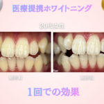 長野市にあるホワイトニングセンター長野駅前店の医療提携ホワイトニング1回で効果を実感した20代女性のビフォーアフター写真