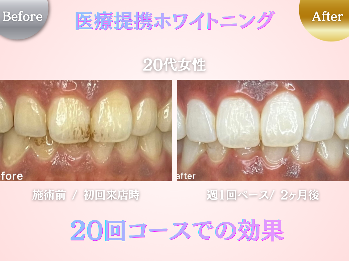 長野市にあるホワイトニングセンター長野駅前店の医療提携ホワイトニング20回コースでの効果を表したビフォーアフター写真