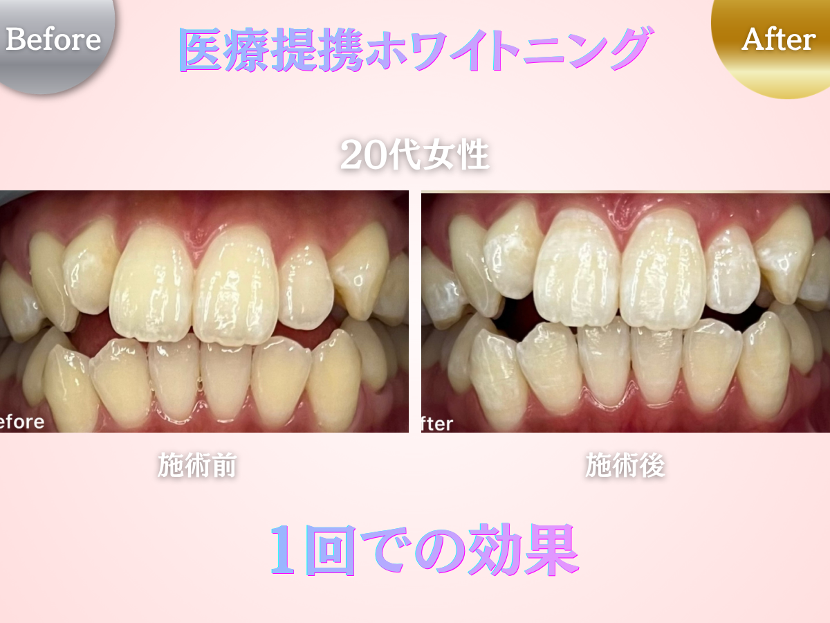 長野市にあるホワイトニングセンター長野駅前店の医療提携ホワイトニング1回で効果を実感した20代女性のビフォーアフター写真