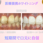 長野市のホワイトニングセンター長野駅前店の医療提携ホワイトニングを受けた女性のビフォーアフター写真