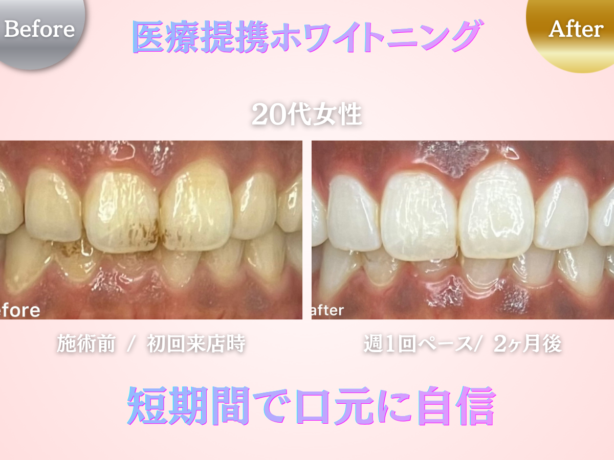 長野市のホワイトニングセンター長野駅前店の医療提携ホワイトニングを受けた女性のビフォーアフター写真