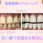 ホワイトニングセンター長野駅前店の医療提携ホワイトニングで歯が白くなり自信が持てた30代男性の写真