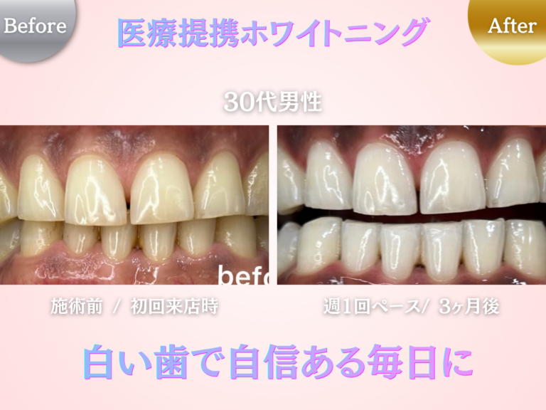 ホワイトニングセンター長野駅前店の医療提携ホワイトニングで歯が白くなり自信が持てた30代男性の写真