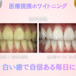 長野市にあるホワイトニングセンター長野駅前店の医療提携ホワイトニングで黄ばみを改善した30代女性のビフォーアフター写真