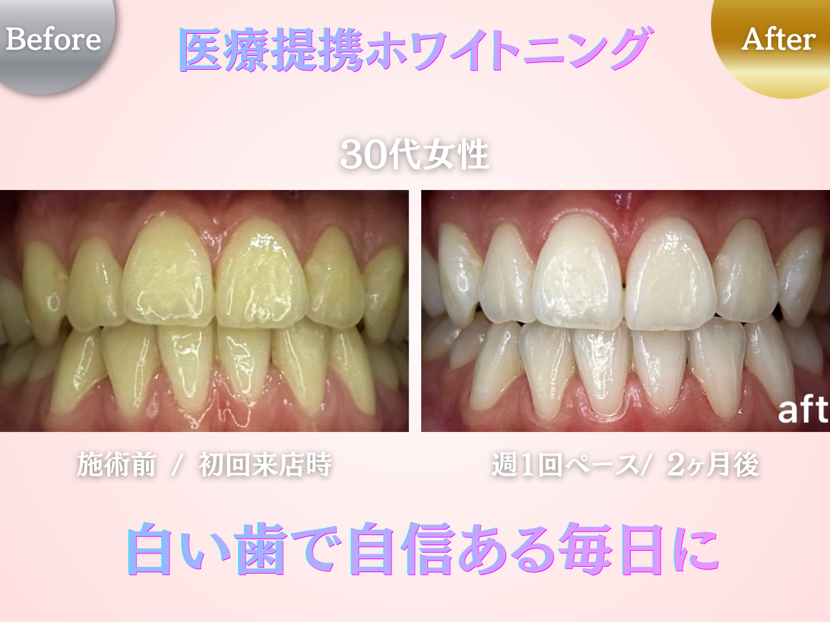 長野市にあるホワイトニングセンター長野駅前店の医療提携ホワイトニングで黄ばみを改善した30代女性のビフォーアフター写真