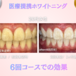 長野市にあるホワイトニングセンター長野駅前店で医療提携ホワイトニングの6回コースで黄ばみを改善した写真